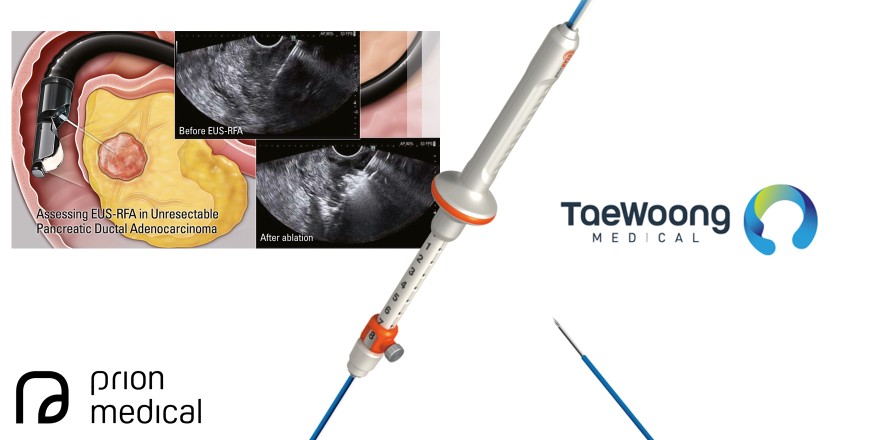 Assessing EUS-guided radiofrequency ablation in unresectable pancreatic ductal adenocarcinoma: a single-center historic cohort study