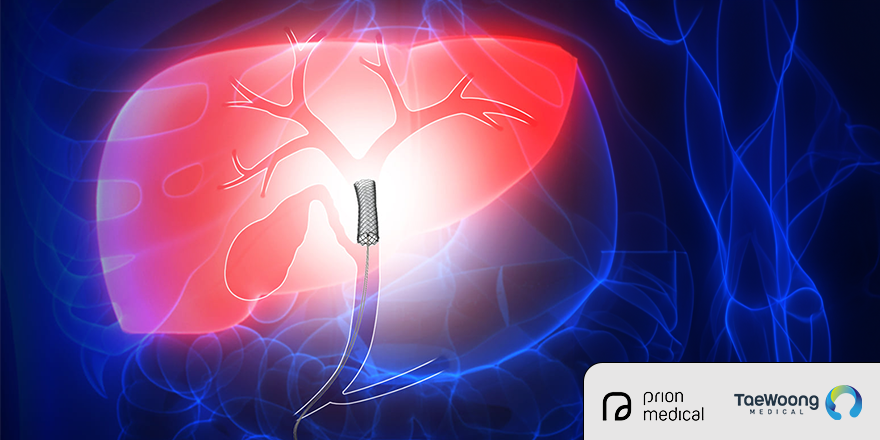 Kaffes™ : Transforming Biliary Stricture Treatment Post-Liver Transplant - A Comparative Study of Fully Covered Metal Stents vs. Multiple Plastic Stents